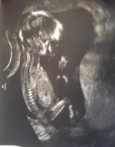 Ultraschallbild Embryo in Steisslage